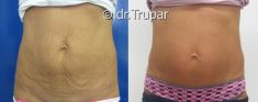 Abdominoplastika (Operace břicha) - fotka před - MUDr. Evžen Trupar Ph.D.