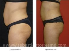 Liposuzione - Foto del prima - Dott. Sebastian Torres Farr