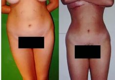 Liposucción - Foto Antes de - Dr. Aristides Arellano-Huacuja