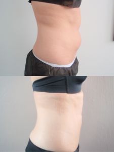 Liposukcia tumescenčná - Fotka pred - ENVY klinika estetickej medicíny