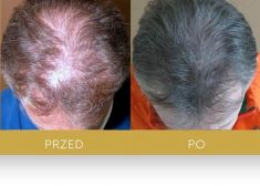 Hair Transplant - Photo before - Dr Turowski Hair Restoration Clinic