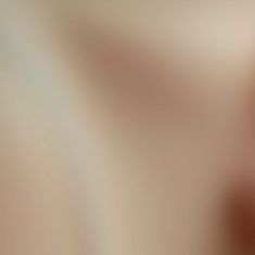 Breast Augmentation - Breast Implants - Photo before - Klinika Laser Esthetic