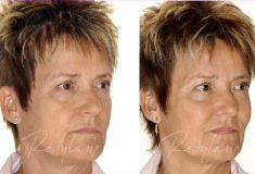 Hyaluronic acid-based wrinkle fillers - Photo before - Dr. Dobos Calin