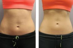 CoolSculpting - Photo before - Lazeo Clinic