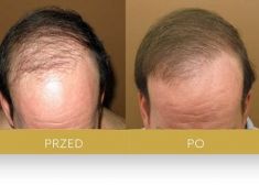 Hair Transplant - Photo before - Dr Turowski Hair Restoration Clinic
