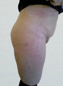 Liposukce - fotka před - OB Care
