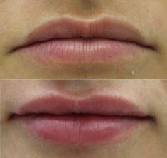 Lip augmentation - cheiloplasty - Photo before - ARS ESTETICA – Klinika Medycyny Estetycznej i Laseroterapii