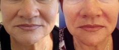 Injekční výplně - fotka před - MUDr. Evžen Trupar Ph.D.
