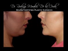 - Photo before - Dr. Rodrigo Morales De la Cerda