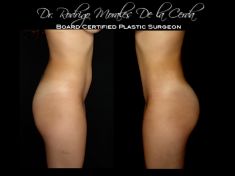 Laser Liposuction - CoolLipo - Photo before - Dr. Rodrigo Morales De la Cerda