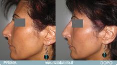 Rinoplastica non chirurgica - Foto del prima - Dott. Maurizio Baldo M.D.