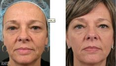 Radiofrequency Rejuvenation (Aluma, accent, TriPollar, Spa RF device, Re-Age) - Photo before - Klinika Laser Esthetic