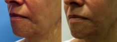 Injekční výplně - fotka před - MUDr. Evžen Trupar Ph.D.