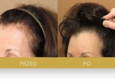 Hair Transplant - Photo before - Dr Turowski Hair Restoration Clinic