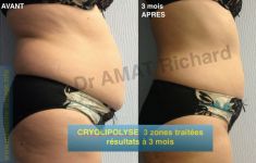 Cryolipolyse - Cliché avant - Dr AMAT - ????Greffe FUE 2.0 Medic Xpert