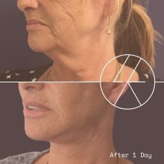 Neck lift - Photo before - MUDr. Lucie Kalinová PhD.