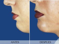 Mentoplastia - Foto Antes de - Clínica Planas