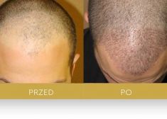 Hair Transplant - Photo before - Dr Turowski Hair Restoration Clinic