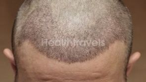 Haartransplantation Wann Fallen Die Krusten Ab Estheticon De