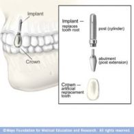 zubni-implantaty