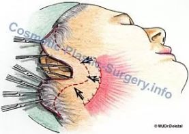 facelift-pritahovani-kuze