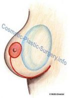 prs-implantat-jizva-celne