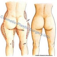 liposuction