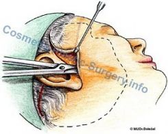 face-lift-odtazena-kuze