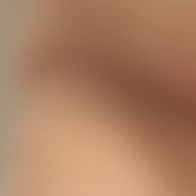 lipo_o