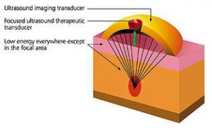 ultrashape-1