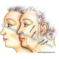 facelifting