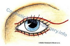 blepharoplasty-2