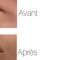 Augmentation des lèvres