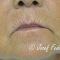 Lipofilling, Lipotransfer (aplikácie vlastného tuku)