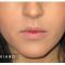 Injections d