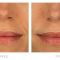Botulinum toxin - Wrinkle Removal