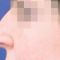 Operácia nosa (Rhinoplastika)