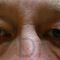 Operácia očných viečok (Blepharoplastika)