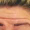 Kwas hialuronowy: Saypha, Restylane, Juvederm, Stylage
