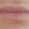 Lippenvergrößerung mit Hyaluronsäure