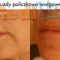 Kwas hialuronowy: Saypha, Restylane, Juvederm, Stylage