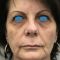 Injections d