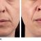 Dermal fillers