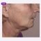 Facelift - Lifestyle lift