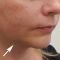 Facelift, SMAS facelifting