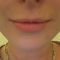 Kwas hialuronowy: Saypha, Restylane, Juvederm, Stylage