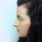 Rhinoplastie