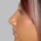 Plastika nosu (Rhinoplastika)