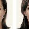 Kwas hialuronowy: Saypha, Restylane, Juvederm, Stylage
