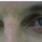 Operácia očných viečok (Blepharoplastika)